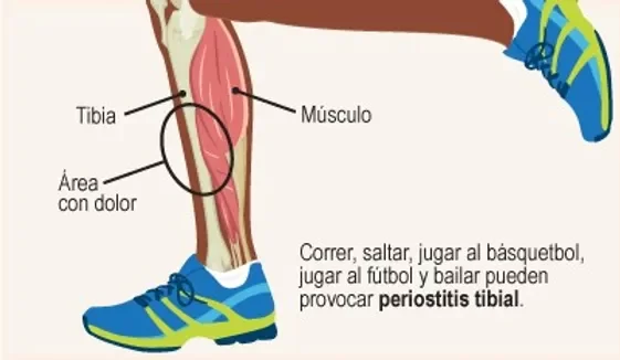 Síndrome de estrés de la tibia medial o periostitis tibial.