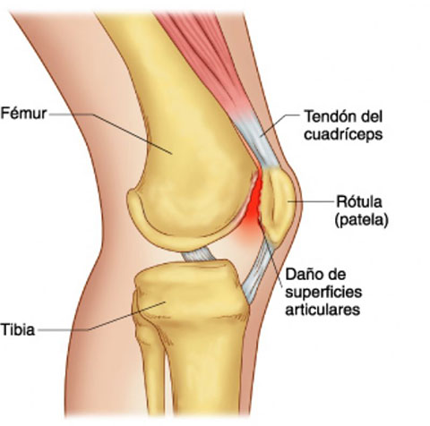 Síndrome de dolor patelofemoral