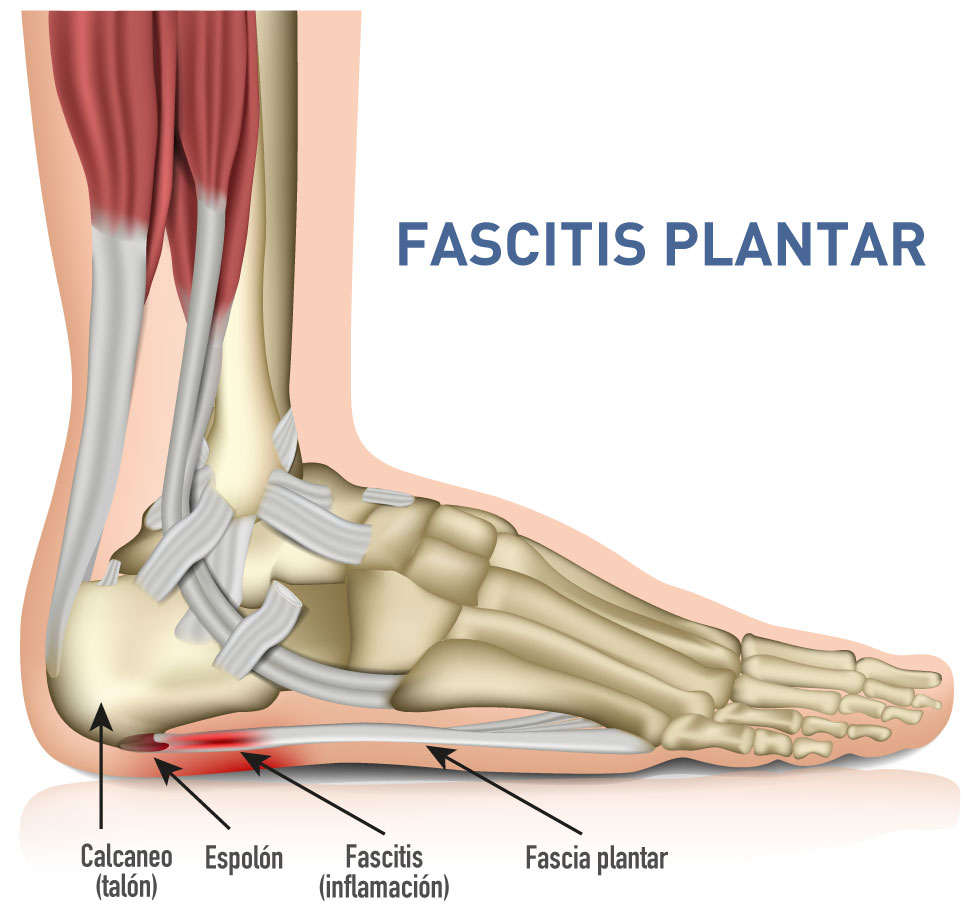 Fascitis plantar en el running.