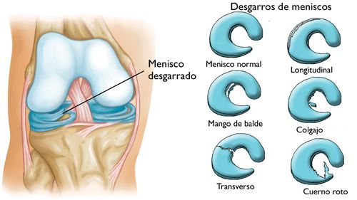 Lesión y Prevención de rotura de menisco